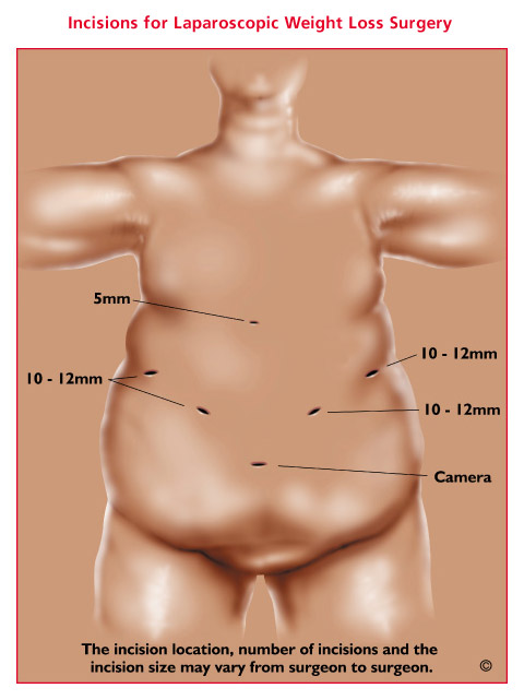 picture of bariatric weight loss surgery